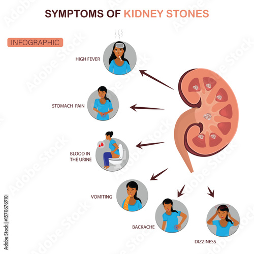  Kidney Stone Symptoms Infographic with Illustrations of Fever, Stomach Pain, Blood in Urine, Vomiting, Backache, and Dizziness. Kidney Stones Symptoms Medical Infographic Illustration.

