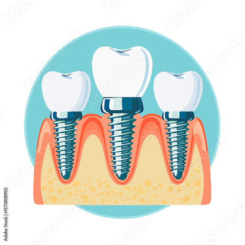 Dental Implants Illustration Showing Tooth Replacement Procedure