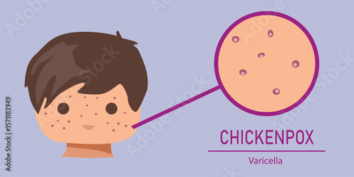 Flat vector illustration of a child with chickenpox rash symptoms on the face — educational medical concept of varicella virus in kids