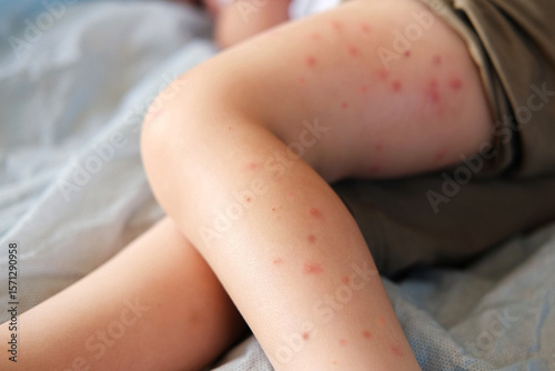 Child scratch body has sensitive itchy skin. Bodily rash. Kid allergy closeup. Little baby scratches eruption. Irritation, hive. Pruritus. Mosquito insect bite. Red from sunburn, Seborrheic Dermatitis