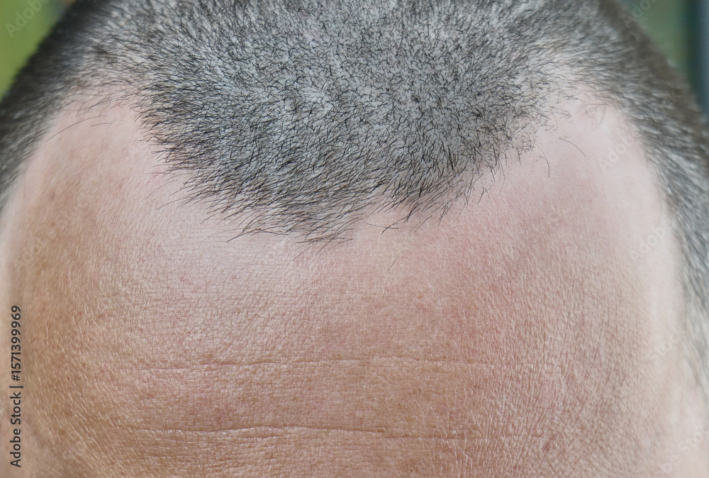 Fototapeta premium Receding hairline visible on male head close up