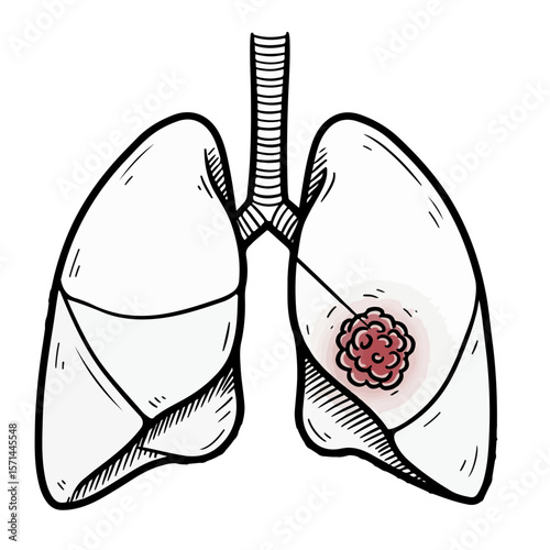 Illustration of lung cancer with malignant tumor, depicting image effects for health and science. Lung cancer graphic emphasizes image effects, showcasing tumor's impact within respiratory system.