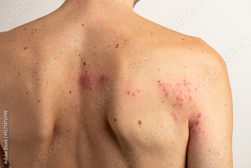 Close up of a man's back and shoulder exhibiting the characteristic rash and blisters of shingles, a reactivation of the varicella zoster virus, causing pain and discomfort