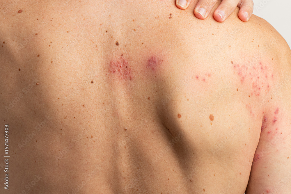 Fototapeta premium Herpes zoster infection causing a painful rash with blisters affecting the back and shoulder, highlighting symptoms associated with the reactivation of chickenpox