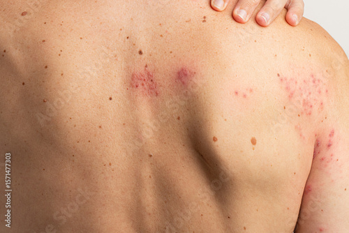 Herpes zoster infection causing a painful rash with blisters affecting the back and shoulder, highlighting symptoms associated with the reactivation of chickenpox