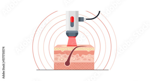 Laser Hair Removal On Skin Layer Illustrating Technology And Beauty Concept