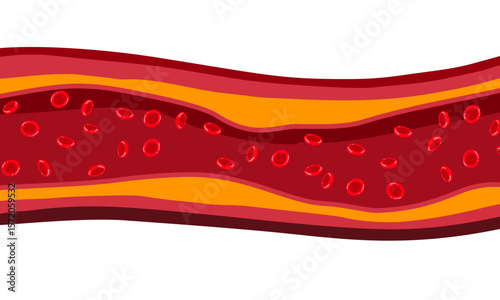 Fatty artery illustration. Atherosclerosis, infarct, ischemia, thrombosis disease. blocked vascular, cholesterol, fatty streak, plaque. vector illustration for medical poster, clinic, education.