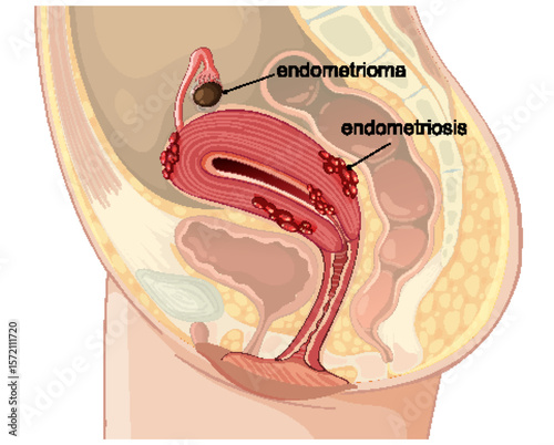 Detailed Medical Illustration of Endometriosis Anatomy