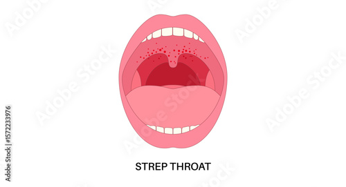 Strep throat poster