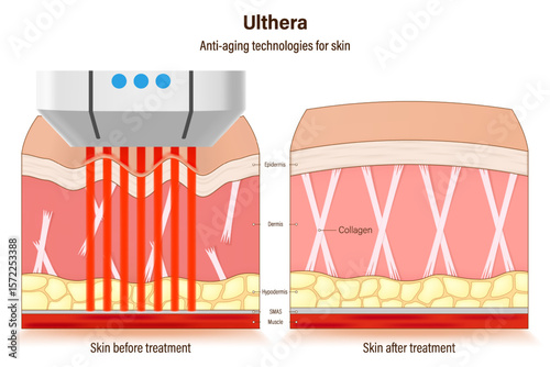 Ulthera treatment. Anti-aging technologies for skin. medical cosmetic procedures for skin. Compare skin condition before and after treatment.