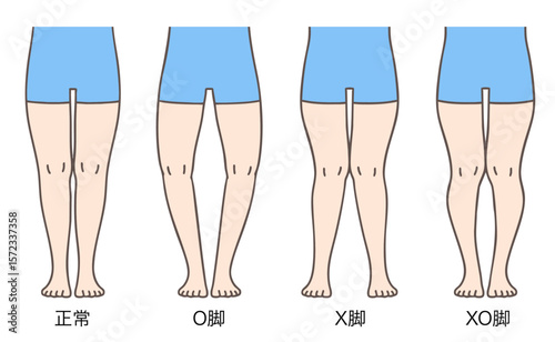 正常な脚、O脚、X脚、XO脚の姿勢とプロポーション