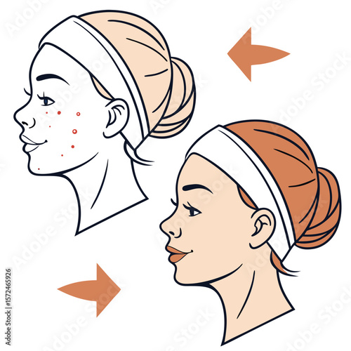 Acne Treatment: A visual guide showcasing the transformation from skin imperfections to a clear complexion, using arrows to highlight the before-and-after stages of a skincare routine.