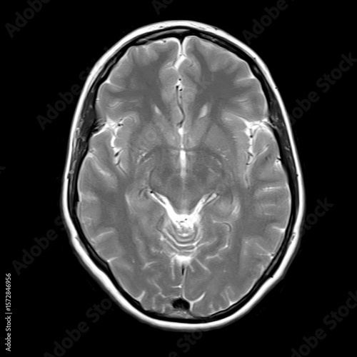 Axial T2-weighted brain MRI of a 40-year-old, showing midbrain, temporal lobes, and hippocampal region. No visible pathology, symmetrical structures, clear ventricles.