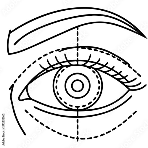 Depicting eye area with surgical markings using fine lines on white background. Eye area with surgical markings, shown with precision and clarity, prepares patients for procedures.