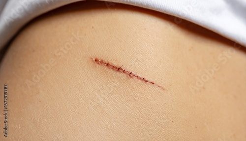 Gojąca się blizna zszyta rana