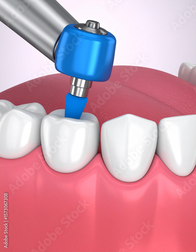 A close-up of dental polishing paste and a rotary brush on an abstract tooth surface, indicating cosmetic dental care.