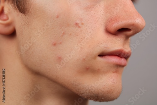 Close-up of a teenage boy’s face with moderate acne, skin blemishes, and inflamed pimples on the cheek and chin