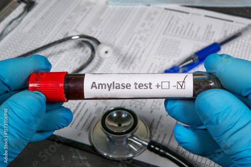 Doctor holding blood sample for amylase test: positive result