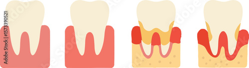 Flat vector gum disease stages from healthy to inflamed, shown in flat icons, isolated on white