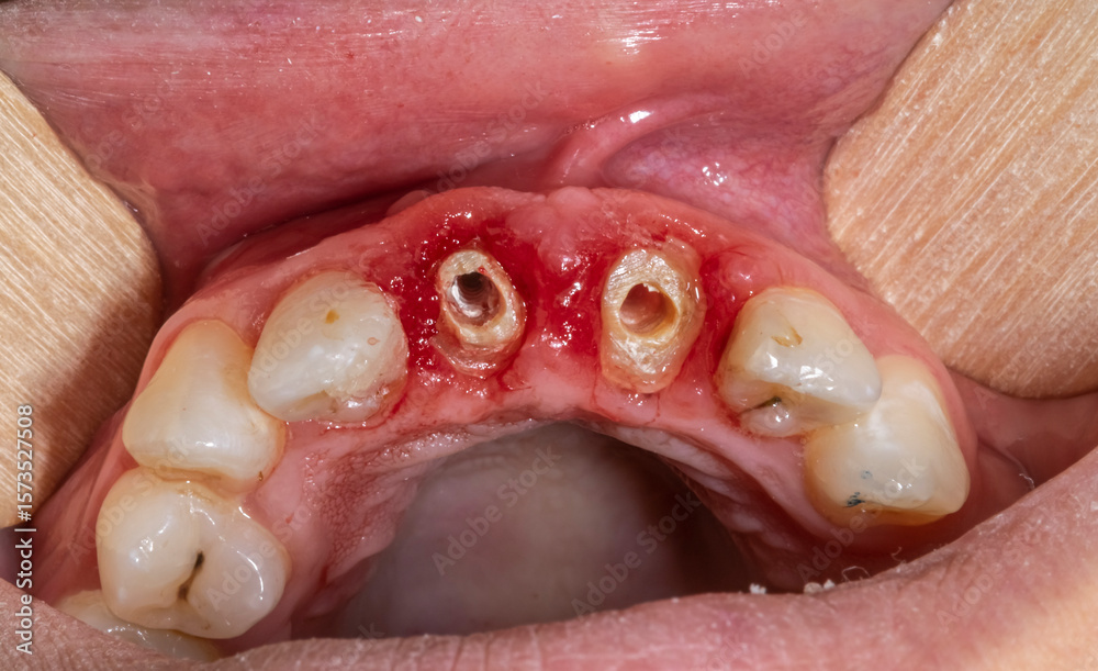 Obraz premium Occlusal view of decayed central incisal tooth with remaining roots in the bloody gingiva gum, palate maxillary arch and open mouth and retracted lips with tongue depressors.