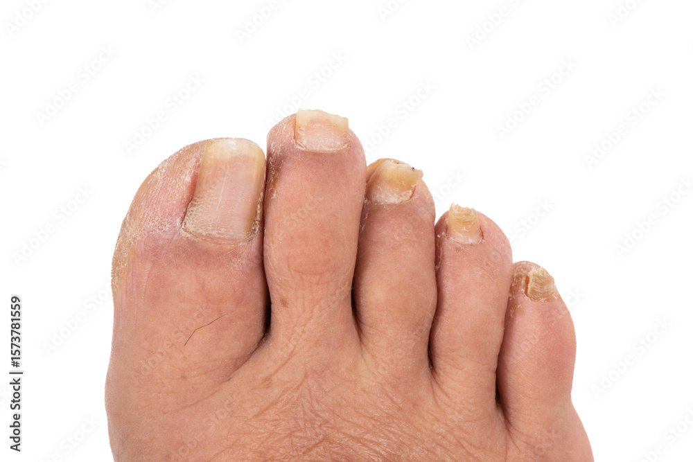 Ταπετσαρία close-up of toenail infection ringworm in human on white background