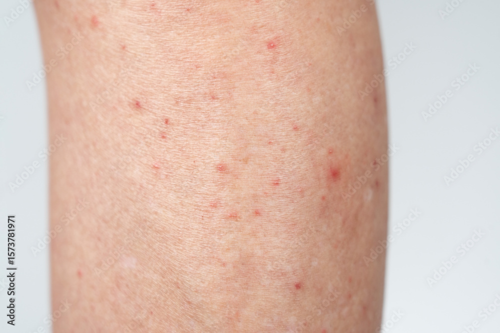 Fototapeta premium Closeup of dermatitis on skin 