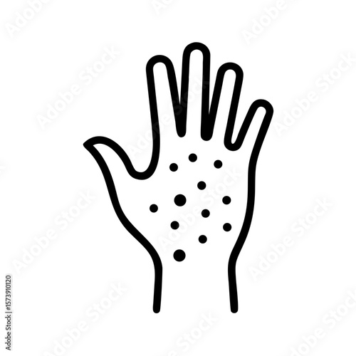 Hand with contact dermatitis illustrating skin irritation condition  