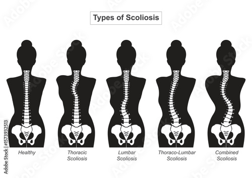White spine on a black body. Scoliosis is a side to side curve.