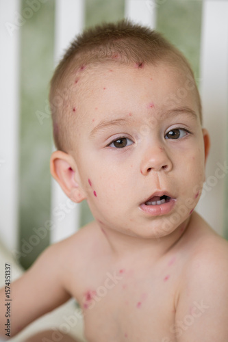 Toddler with Chickenpox Sitting in Bed