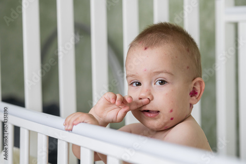 Toddler with Chickenpox Sitting in Bed