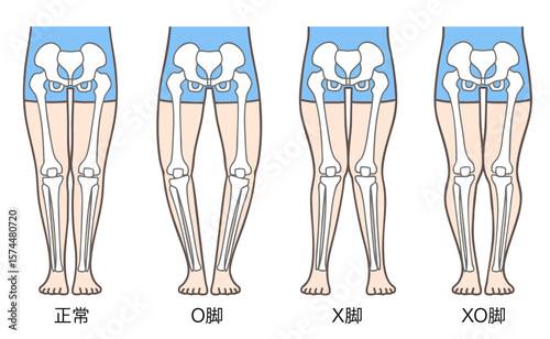 正常な脚、O脚、X脚、XO脚の姿勢と骨格