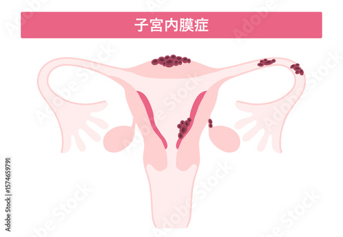 子宮内膜症