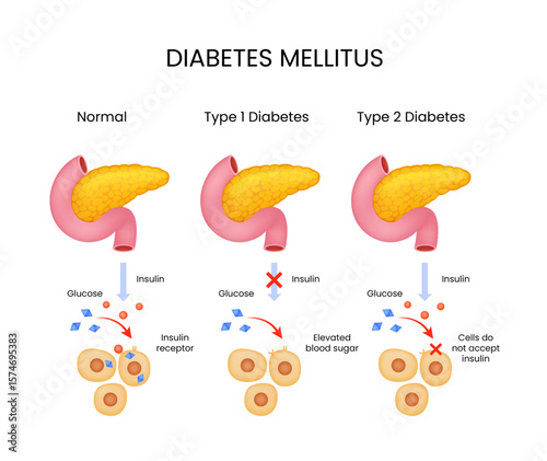 Diabetes Mellitus Types, Insulin, and Glucose Explained