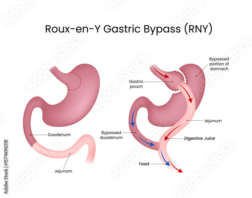 Roux-en-Y Gastric Bypass (RNY)