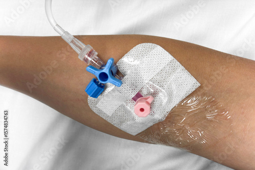 Close up view of a patient’s arm with a pink intravenous (IV) cannula and blue three way stopcock valve inserted for hospital treatment, fluid therapy, or medication administration in a clinical setti