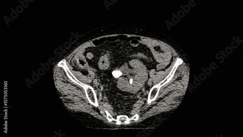 A pelvic ectopic kidney with a renal stone , abdomen CT scan 