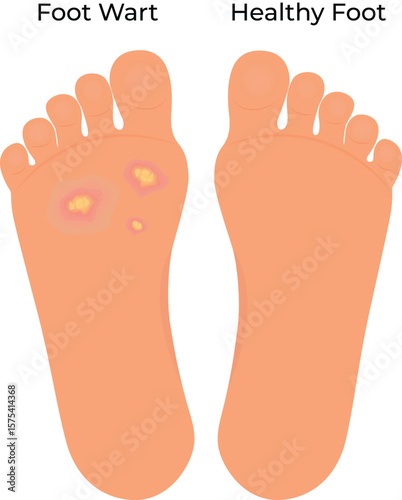 Foot Wart vs Healthy Foot A Comparative Illustration