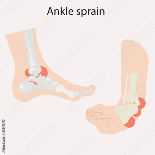 Ankle sprain vector illustration showing swelling, bruising, pain, and limited motion; highlights similar conditions like fractures and tendon injuries, leg
