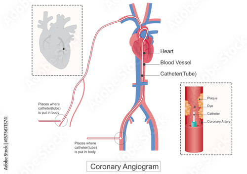 A coronary angiogram CAG is a specialized X ray test used to visualize the coronary arteries.