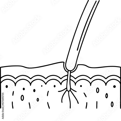 Laser light hair removal illustration showing pulling up skin for aesthetic treatments. Laser light hair removal shows skin being penetrated with light to target follicle, skin diagram showing layers.