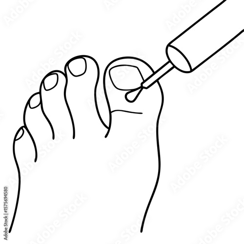 Wart being removed from foot with medical applicator. Wart being removed shows foot care with liquid medicine applied to affected area of skin.