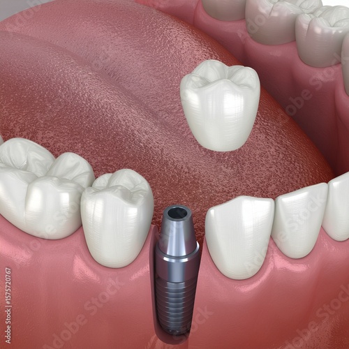 Dental Implant Placement Procedure Showing Implant Post Crown and Gum Tissue in a Human Mouth for Dental Health Education