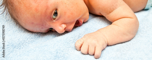newborn baby lying down. jaundice pimples on skin. close-up portrait