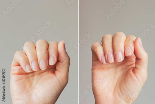 Close-up comparison before and after of a well-groomed female hands with a beautiful nude manicure on a gray background. Beauty and hand care