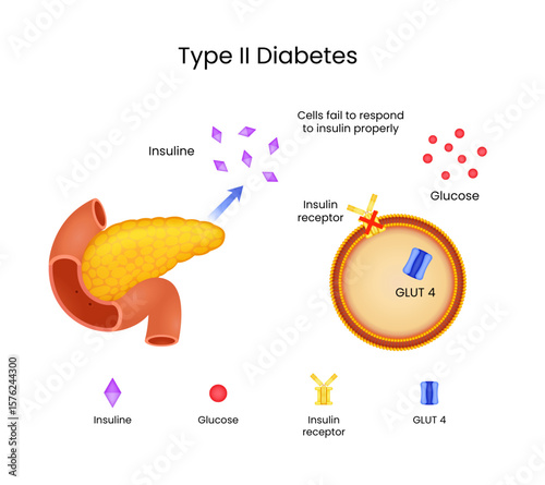 Type II Diabetes Insulin Resistance Explained