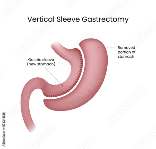Vertical Sleeve Gastrectomy Anatomical Illustration