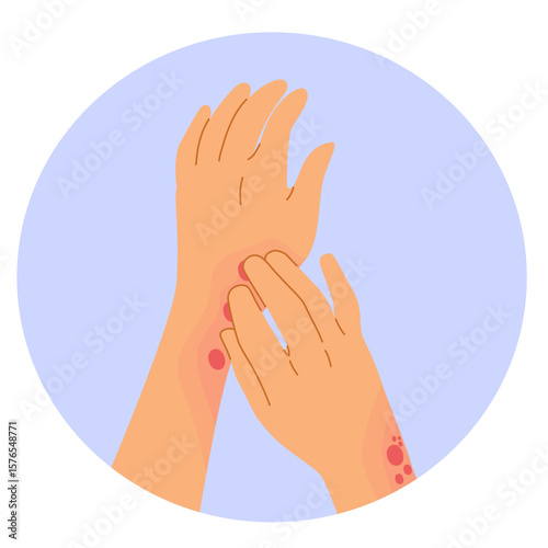 A cartoon vector showing close-up of female hands scratching irritated skin with rash, perfect for dermatology, skincare or medical awareness content
