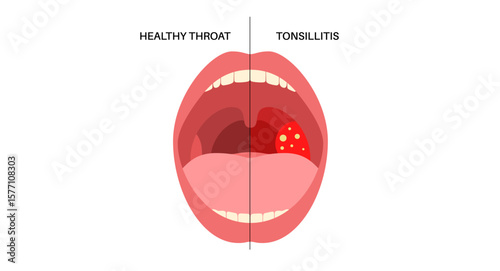 Tonsillitis Oral Desease