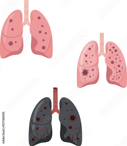 Three sets of lungs showing progression of damage, from healthy pink to diseased and blackened.