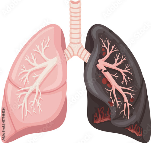 Healthy and diseased lungs contrasted, highlighting the effects of smoking.